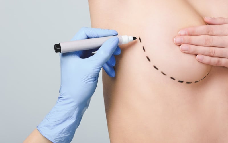 borstvergroting lipofilling, donorplaat lipofilling borsten