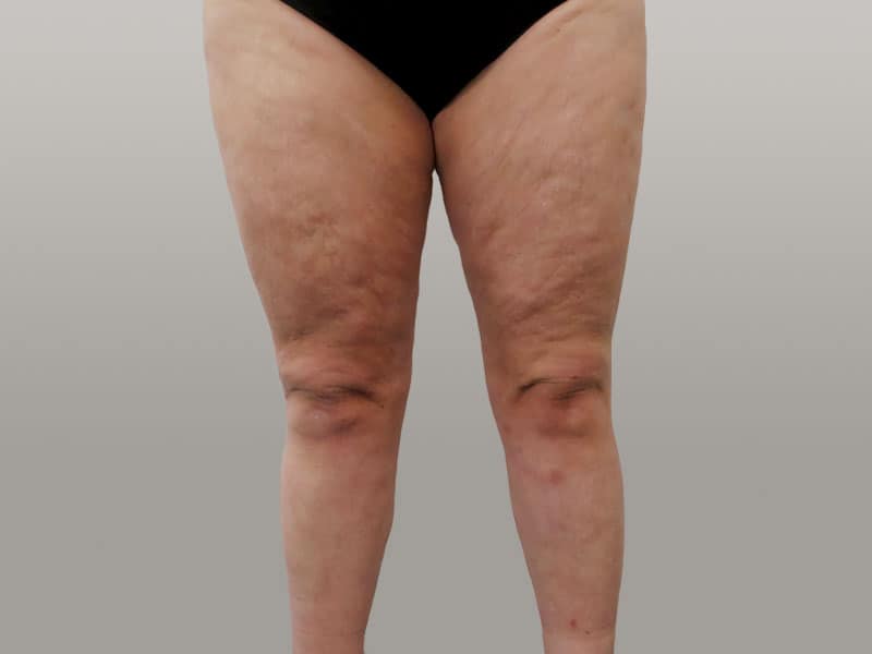 lipoedeem benen, lipoedeem behandeling benen, liposuctie benen, lipoedeem liposuctie, liposuctie voor na