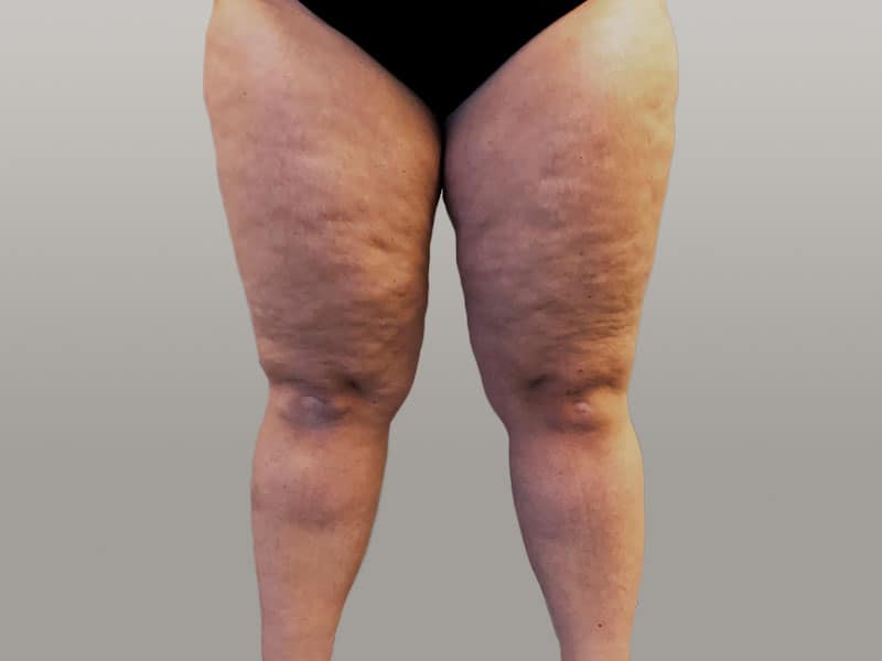 lipoedeem benen, lipoedeem behandeling benen, liposuctie benen, lipoedeem liposuctie, liposuctie voor na