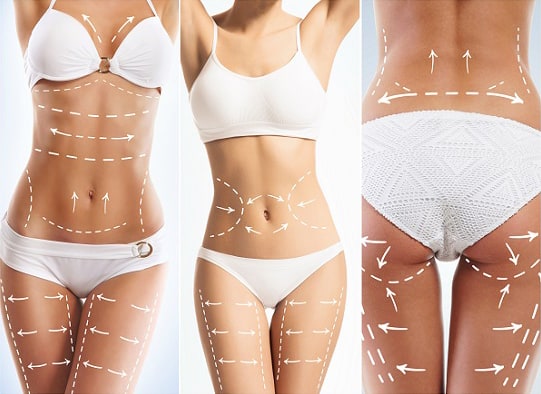 liposuctie behandeling, liposuctie gebieden, resculpt clinic