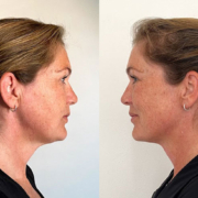 necktite before and after treatment, necktite before after, necklift before and after, resculpt clinic, necklift experience