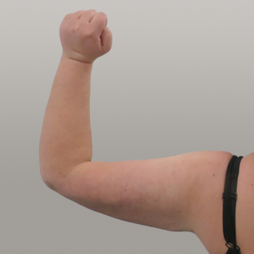 lipoedeem, resculpt clinic, lipoedeem armen, ervaring, resultaat na, lipoedeem armen voor na