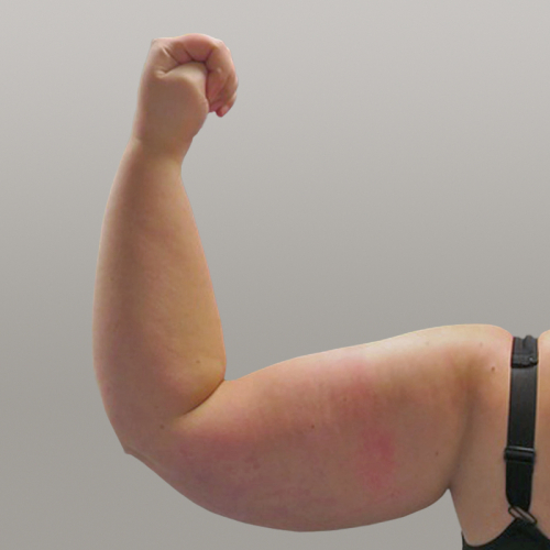 lipoedeem, resculpt clinic, lipoedeem armen, ervaring, resultaat voor, lipoedeem armen voor na