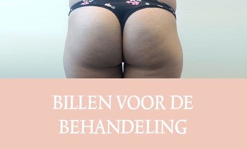 cellulite, cellfina, cellulite behandeling, resculpt clinic, cellulite resultaten