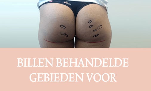 cellulite, cellfina, cellulite behandeling, resculpt clinic, cellulite resultaten