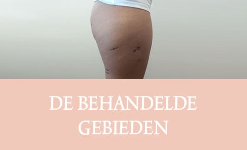 cellulite, cellfina, cellulite behandeling, resculpt clinic, cellulite resultaten