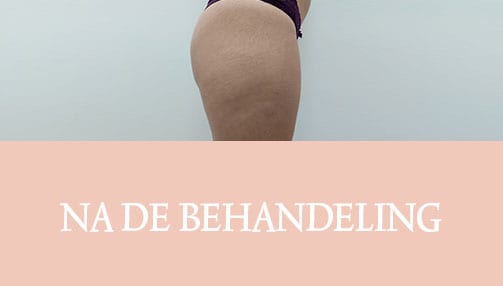 cellulite, cellfina, cellulite behandeling, resculpt clinic, cellulite resultaten