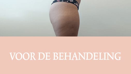 cellulite, cellfina, cellulite behandeling, resculpt clinic, cellulite resultaten