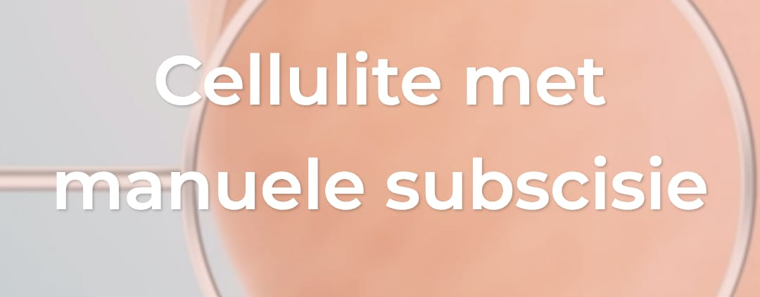 Cellulite met manuele subscisie, cellulite