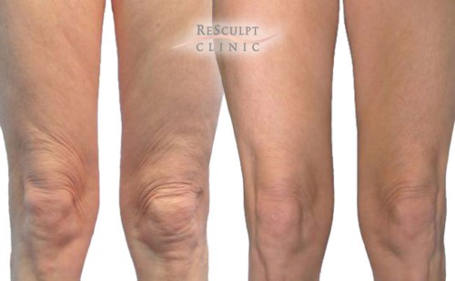 bodytite treatment, legs fat removal, legs before and after treatment, resculpt clinic