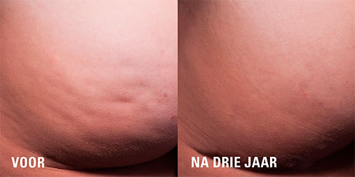 cellulite, cellfina resultaat, cellulite resultaat, cellfina, resculpt clinic, cellulite behandeling, behandeling dermatoloog