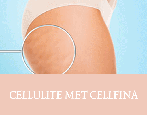 cellulite, cellfina, resculpt clinic, cellulite behandeling, behandeling dermatoloog