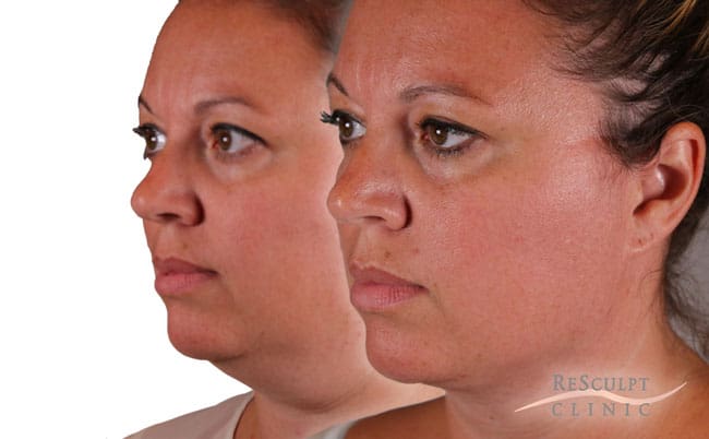 facetite treatment facetite, resculpt clinic, double chin