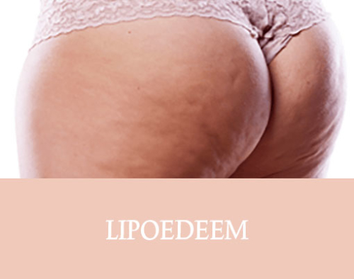 lipoedeem, lipoedeem behandeling, cellulite behandeling, behandeling dermatoloog, lipoedeem behandelen, lipoedeem weg