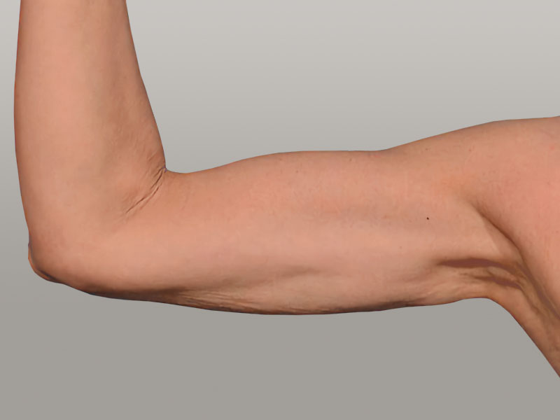 bodytite, bodytite upper arm, chicken breast removal, upper arm tightening, bodytite before after, resculpt clinic