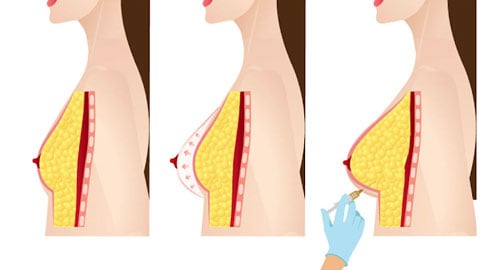 Breast augmentation with your own fat, breast augmentation, lipofilling breast, larger breasts