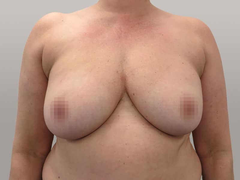 breast reduction, breast reduction liposuction, breast tightening, bodytite, resculpt clinic, breast reduction before and after