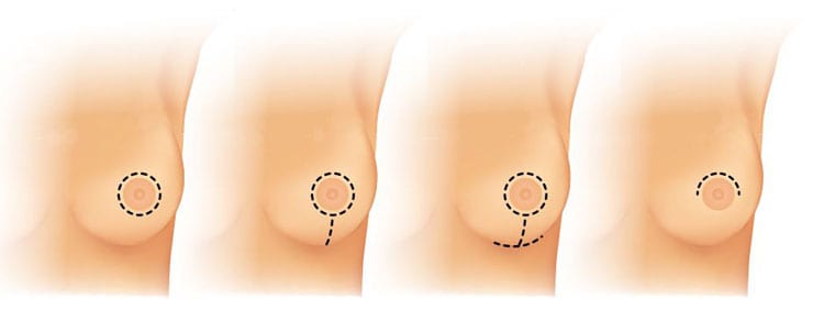 borstverkleining, borstverkleining littekens, borstlift, borstverkleining liposuctie