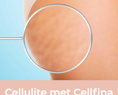cellulite, cellfina, cellulite behandeling, anti cellulite, cellulitis behandeling, resculpt clinic