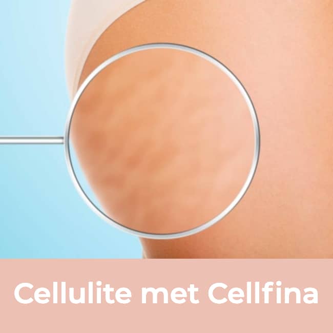 cellulite, cellfina, cellulite behandeling, anti cellulite, cellulitis behandeling, resculpt clinic