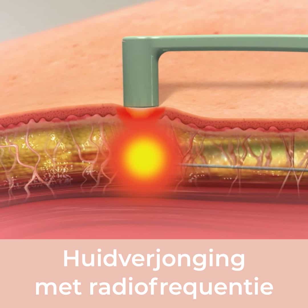 facetite, huidverjonging, radiofrequentie, huidverstrakking, halslift zonder operatie