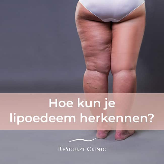 lipoedeem, lipoedeem herkennen, lipoedeem klachten, lipoedeem klachten, lipoedeem symptomen