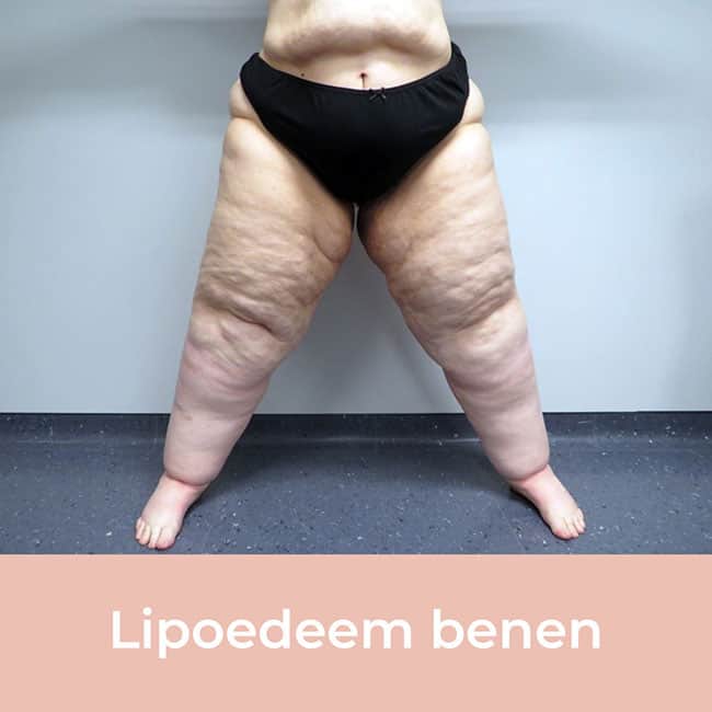 Lipoedeem herkennen? Lees de klachten en symptomen - ReSculpt Clinic Lipoedeem Herkennen? Lees De Klachten En Symptomen - Resculpt Clinic