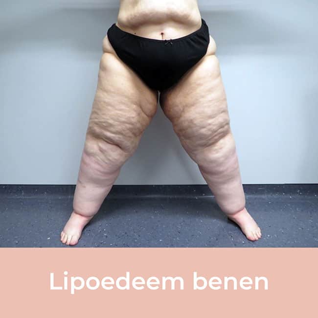 lipedema legs, fat accumulation legs, lipedema cause