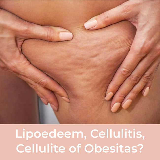 lipoedeem, lipoedeem herkennen, lipoedeem klachten, lipoedeem oorzaak, cellulitus, cellulite, obesitas, resculpt clinic