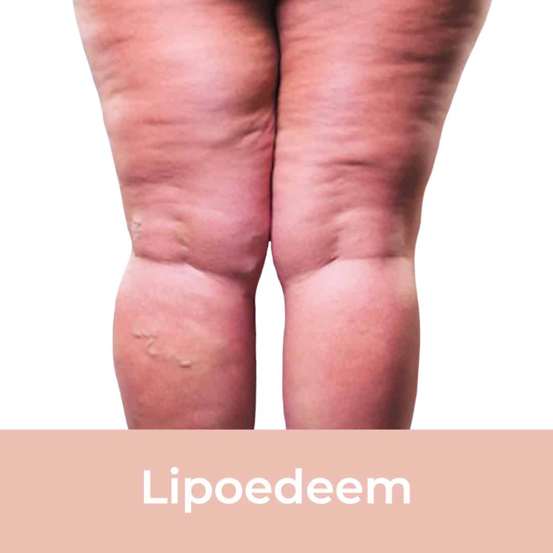 lipoedeem, lipoedeem behandeling, lipedema dermatoloog, lipoedeem behandelen, lipoedeem weg, resculpt clinic, dikke benen ziekte