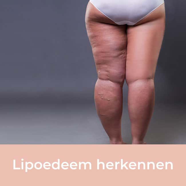 lipedema, recognize lipedema, lipedema complaints, lipedema symptoms, lipedema symptoms