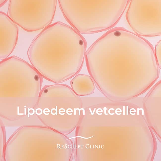 lipoedeem herkennen, lipoedeem vetcellen, lipoedeem behandeling, lipoedeem vetcellen, lipoedeem oorzaak