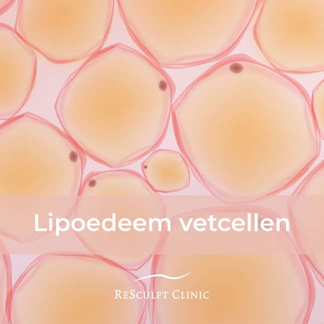 lipedema recognition, lipedema fat cells, lipedema treatment, lipedema fat cells, lipedema cause