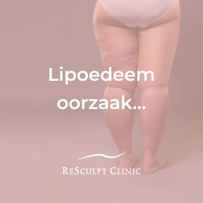 lipoedeem oorzaak, lipoedeem, resculpt clinic