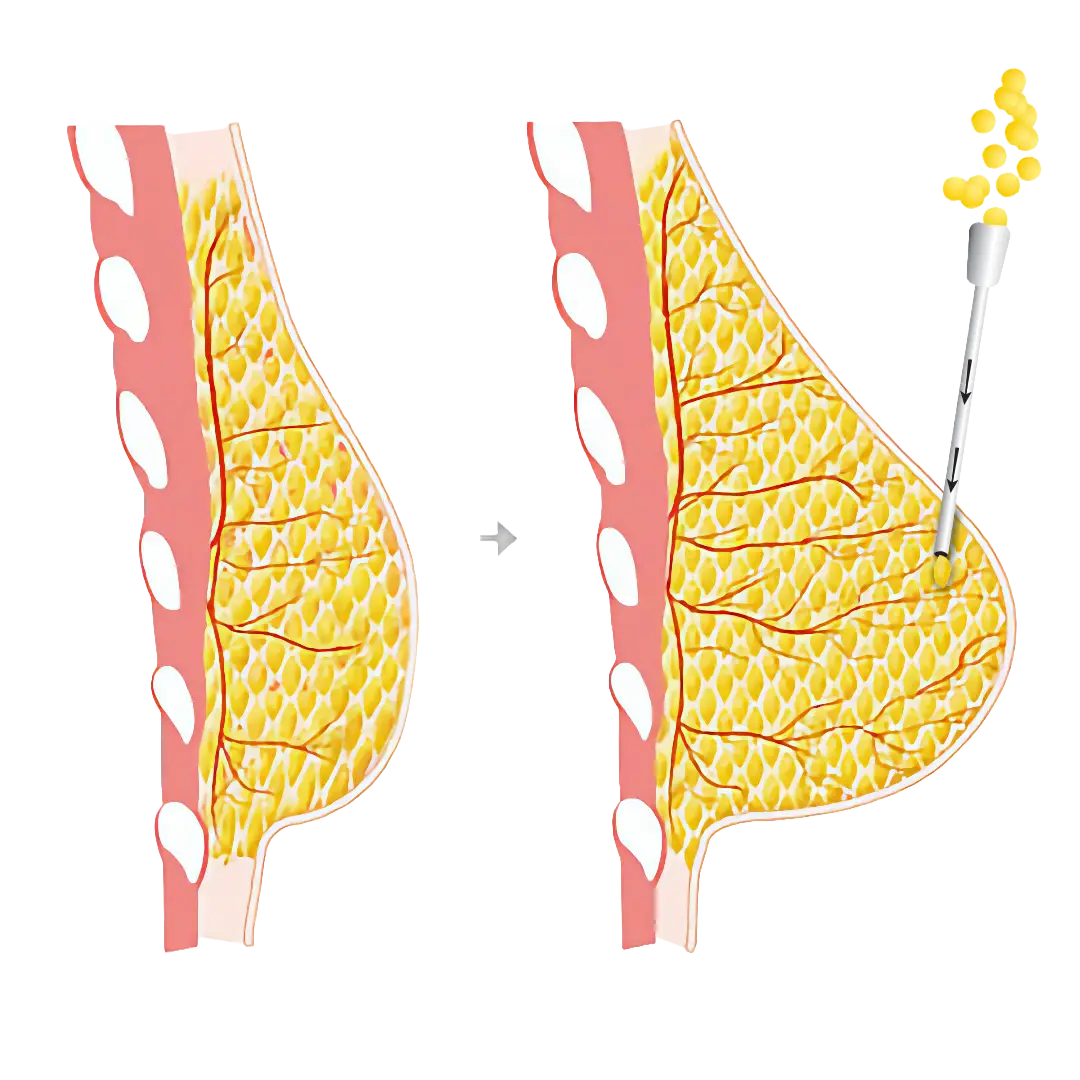 ReSculpt Clinic, Lipofilling uitleg infographic, Amsterdam