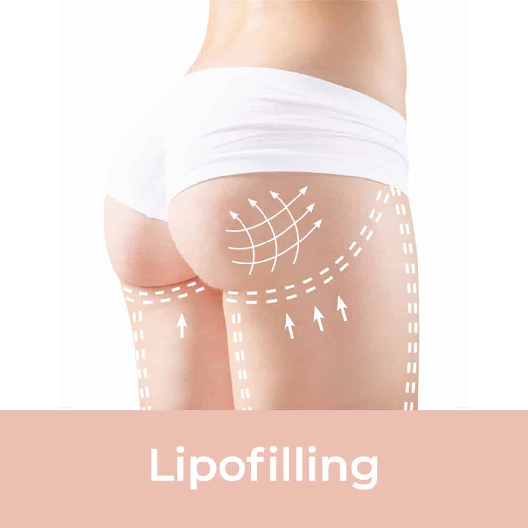 lipofilling, lipofilling behandeling, lipofill, lipofilling gezicht, resculpt clinic