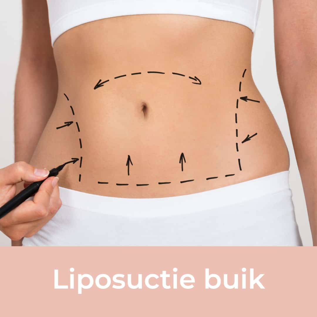 liposuctie buik, liposuctie buik behandeling,buikvet verwijderen, liposculpture buik, buikvet,