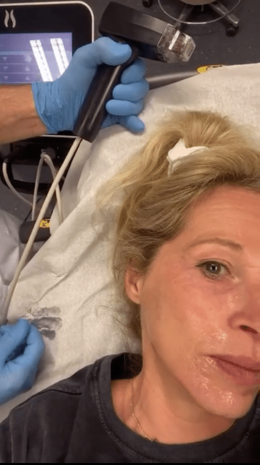 microneedling, morpheus8, resculpt clinic, live treatment, maaike dorsteen, furrow