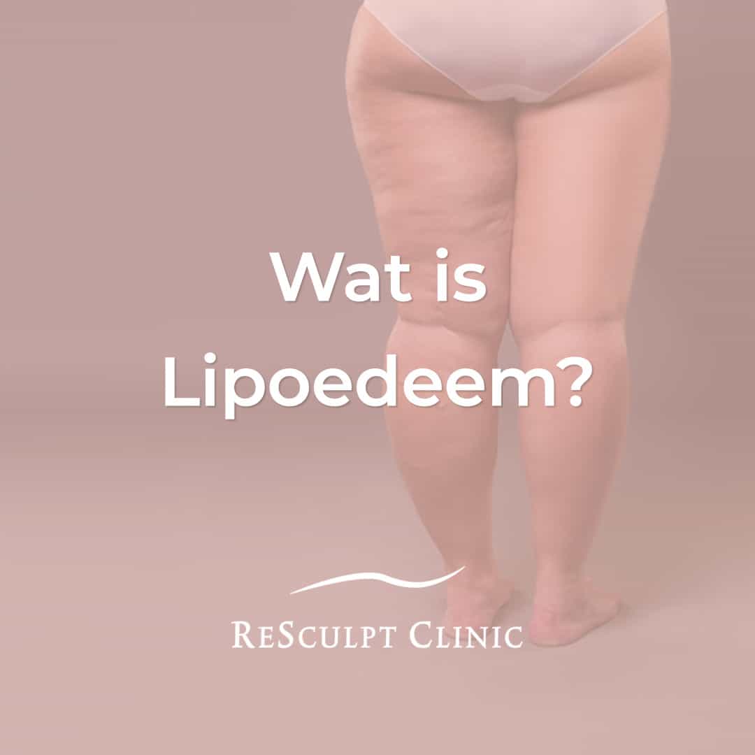 wat is lipoedeem, lipoedeem wat is dat, lipoedeem, resculpt clinic
