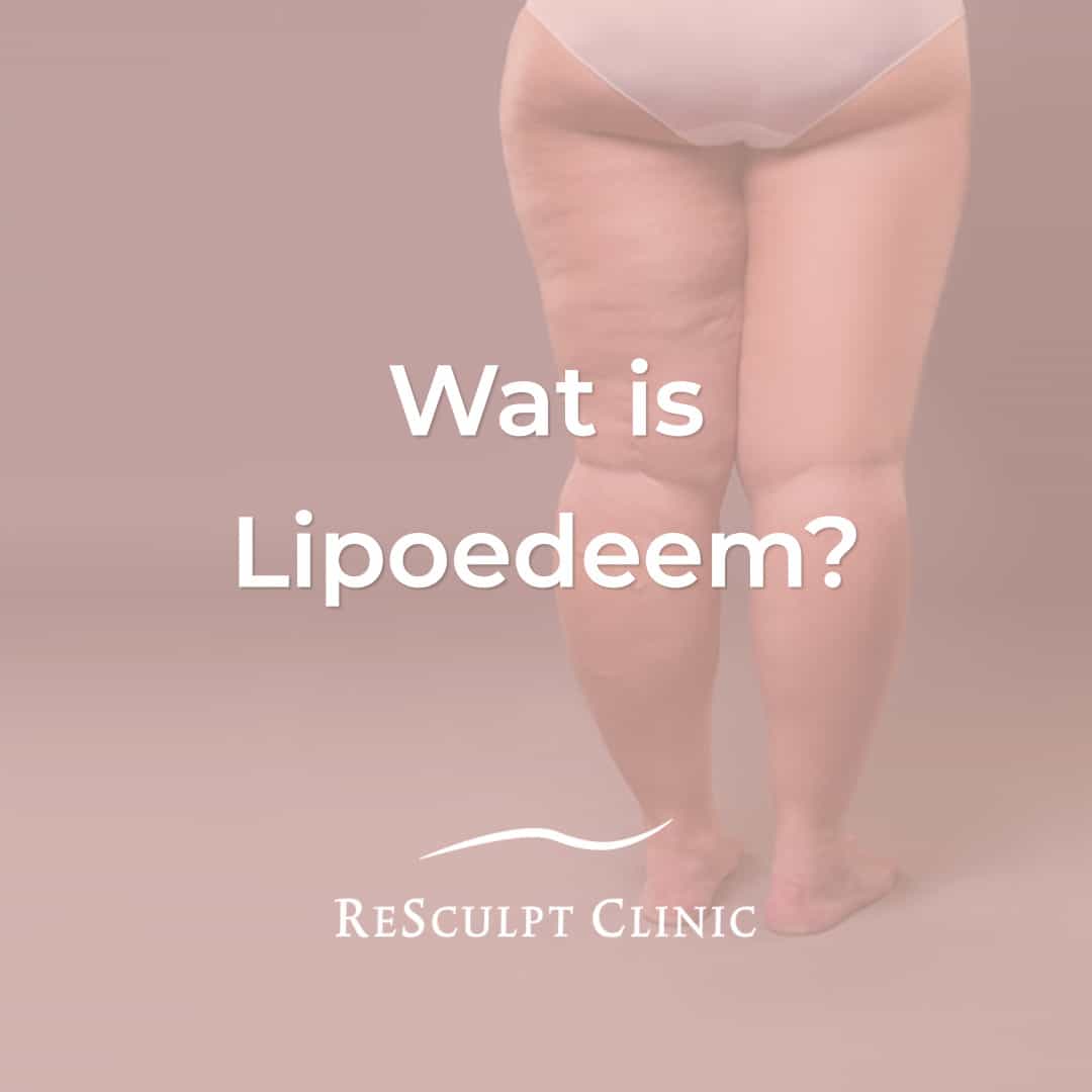 wat is lipoedeem, lipoedeem wat is dat, resculpt clinic,