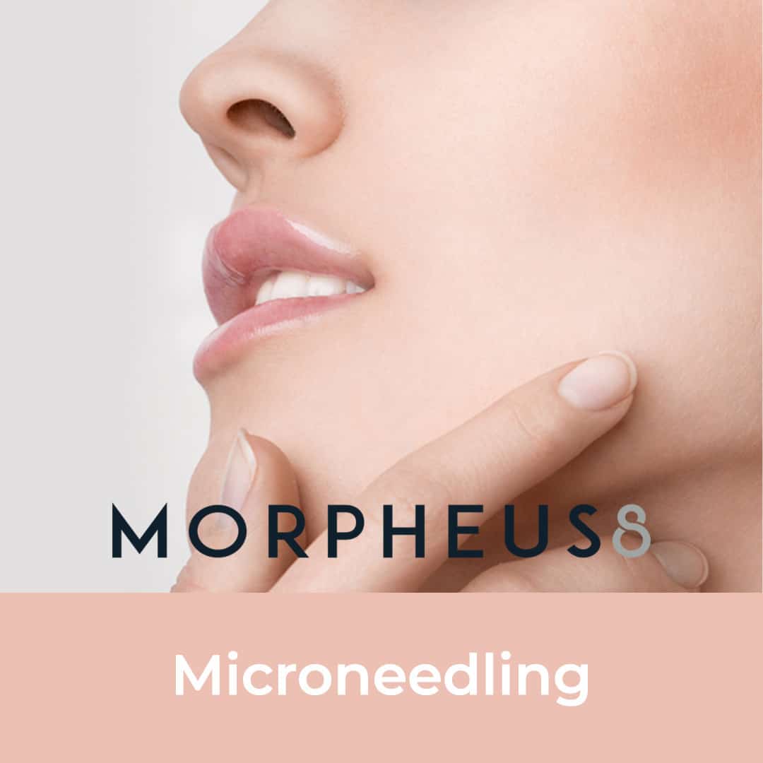 Morpheus8, microneedling, microneedlign treatment, morpheus treatment, skin tightening, skin rejuvenation, resculpt clinic