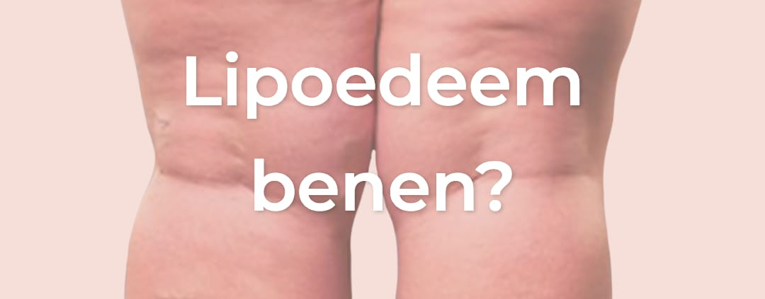 lipoedeem benen, lipoedeem behandeling benen, liposuctie benen, lipoedeem liposuctie, liposuctie voor na
