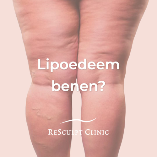 lipoedeem benen, lipoedeem behandeling benen, liposuctie benen, lipoedeem liposuctie, liposuctie voor na