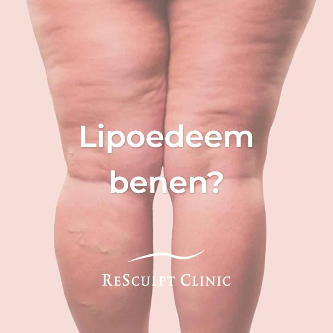 lipoedeem benen, lipoedeem behandeling benen, liposuctie benen, lipoedeem liposuctie, liposuctie voor na