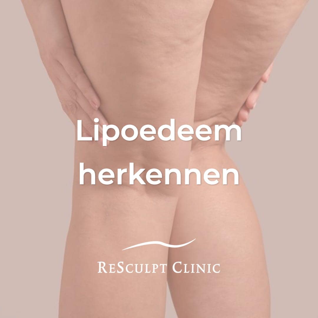 lipedema, recognize lipedema, lipedema complaints, lipedema symptoms, lipedema symptoms