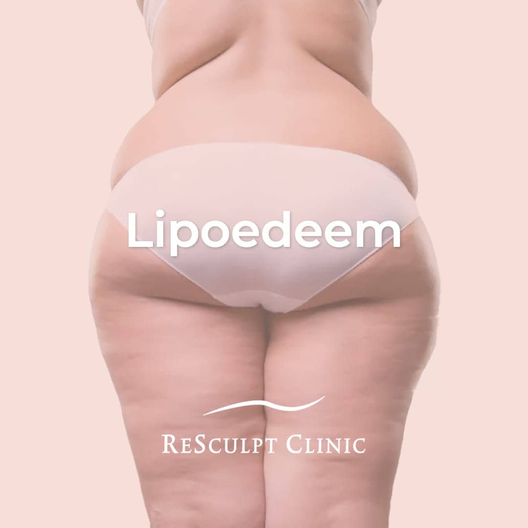 lipoedeem, lipoedeem behandeling, lipedema dermatoloog, lipoedeem behandelen, lipoedeem weg, resculpt clinic, dikke benen ziekte