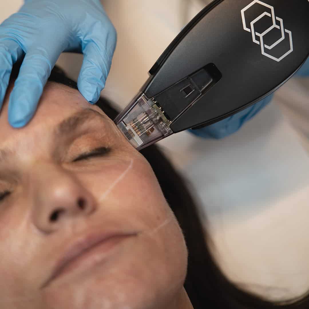 resculpt clinic, morpheus8, microneelding amsterdam