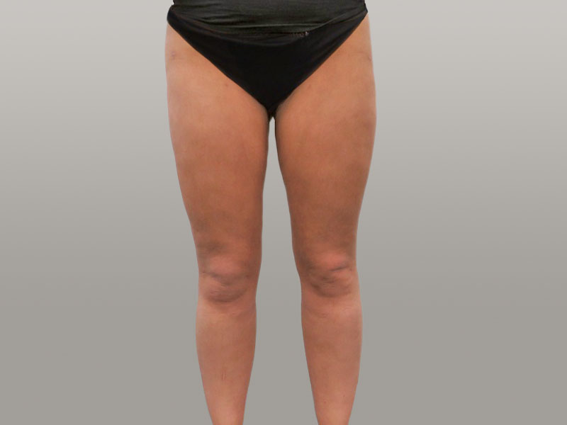 Liposuctie lipoedeem benen, NA, vet verwijderen, voor na behandeling, before after