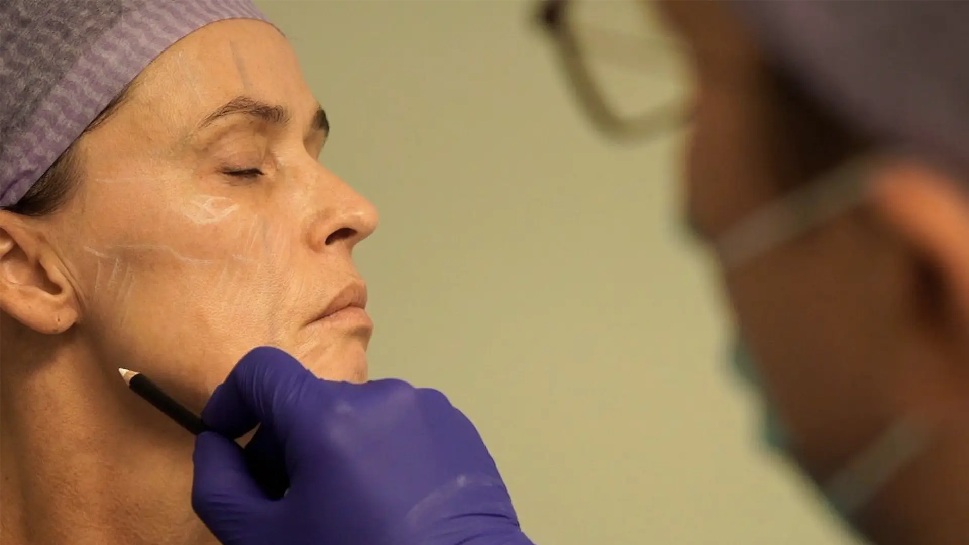 ReSculpt Lipofilling, gezicht, eigen vet met liposuctie, lipofilling gezicht