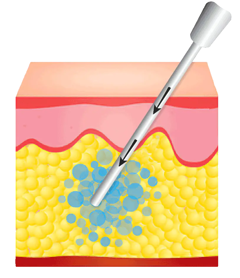 Liposuctie uitleg infographic
